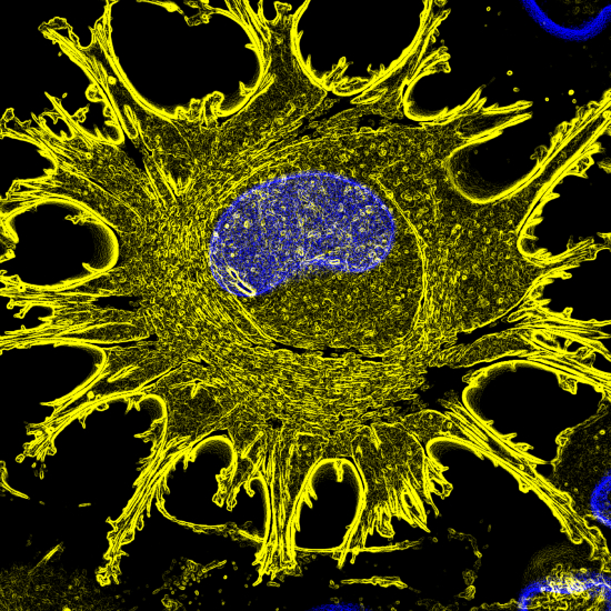 Microscopic image of human melanoma cell